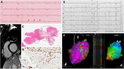 The “arrhythmic” presentation of peripartum cardiomyopathy: case series and critical review of the literature